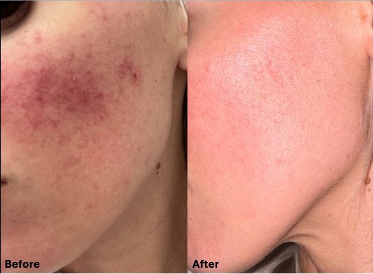 Skin Rejuvenation - Before and After