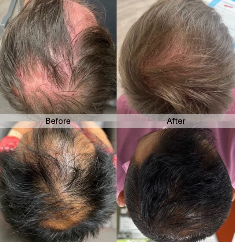 Hair Restoration - Before and After