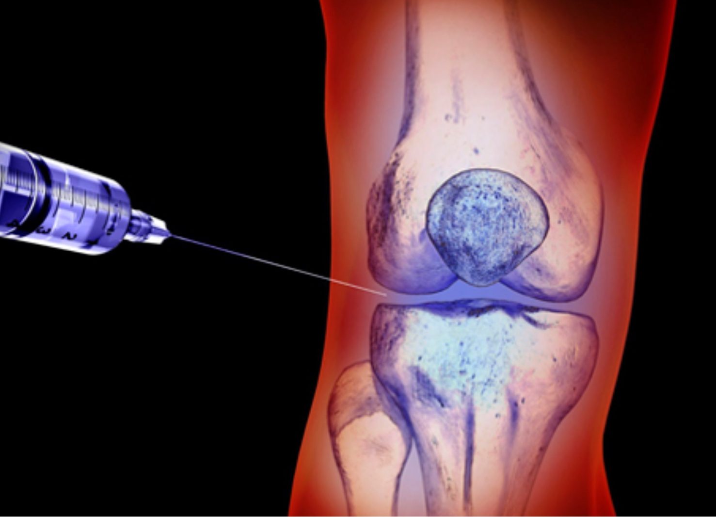 Joint & Tissue Injections - RegenRx